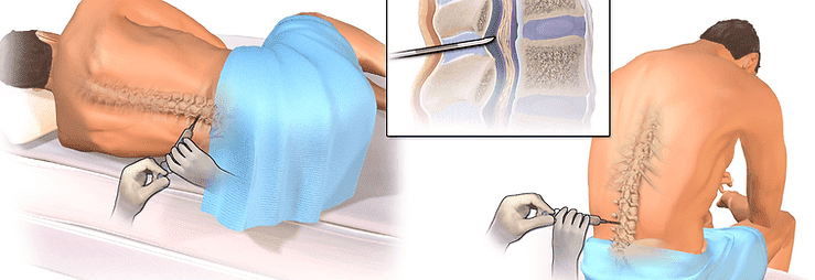 lomber ponksiyon nedir